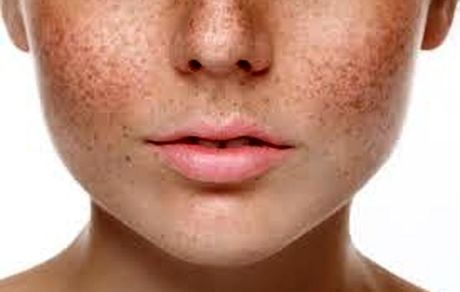 بررسی اسباب و علائم بیماری پوستی کلف و ملاسما براساس منابع طب سنتی ایران