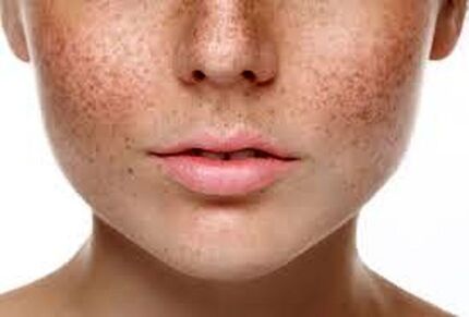 بررسی اسباب و علائم بیماری پوستی کلف و ملاسما براساس منابع طب سنتی ایران