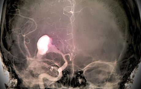 هوش مصنوعی خونریزی مغزی را تشخیص می‌دهد