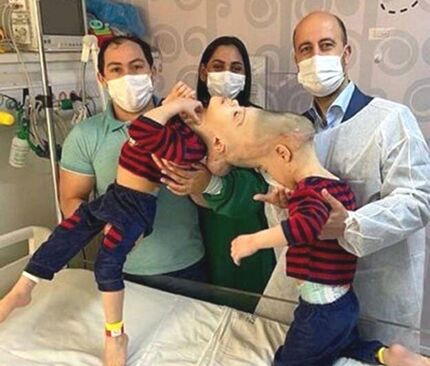 دوقلوهای به هم چسبیده برزیلی در عمل ۲۷ ساعته جدا شدند