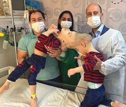 دوقلوهای به هم چسبیده برزیلی در عمل ۲۷ ساعته جدا شدند