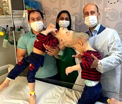 دوقلوهای به هم چسبیده برزیلی در عمل ۲۷ ساعته جدا شدند