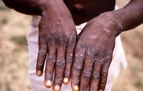 آبله میمونی به ۲۳ کشور رسید