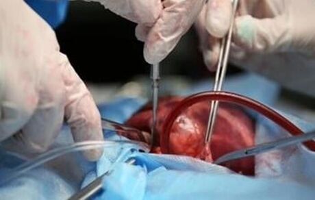 مراقبت های بیماران پیوندی در اپیدمی کرونا