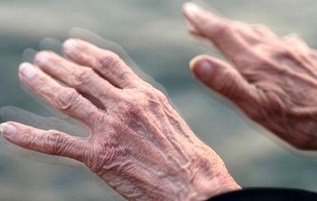 پارکینسون چه بیماری است