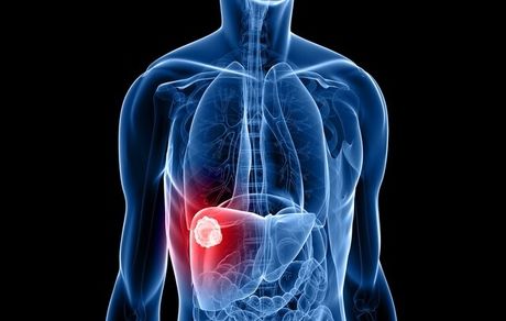 تشخیص سرطان کبد با هوش مصنوعی ممکن شد