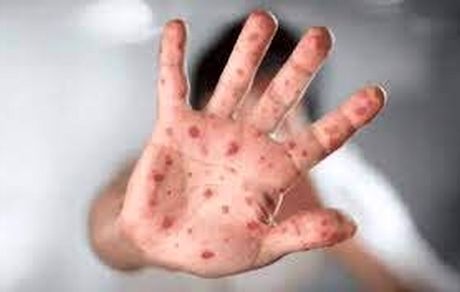 شباهت علائم آبله میمونی و آبله مرغان / نحوه نمونه گیری از افراد مشکوک به بیماری