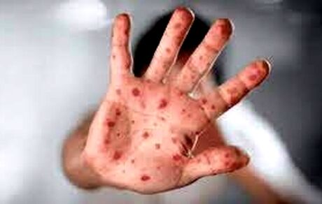 شباهت علائم آبله میمونی و آبله مرغان / نحوه نمونه گیری از افراد مشکوک به بیماری