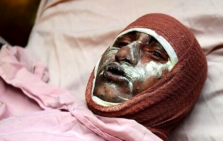 میزان سوختگی در کشورمان ۸ برابر میانگین جهانی است