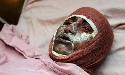 میزان سوختگی در کشورمان ۸ برابر میانگین جهانی است