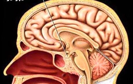 بیماری‌ها و اختلالات غده هیپوفیز