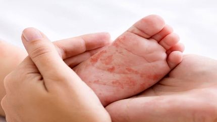 شناسایی بیش از ۳۵۰ هزار بیمار خاص در کشور 