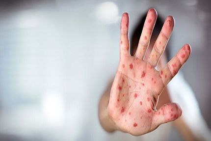 افزایش موارد ابتلا به سرخک در چند ماه اخیر در استان خوزستان