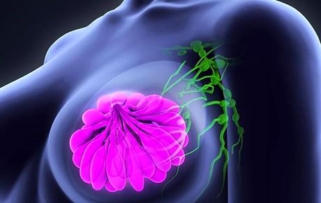 سرطان پستان / وابسته به سبک زندگی