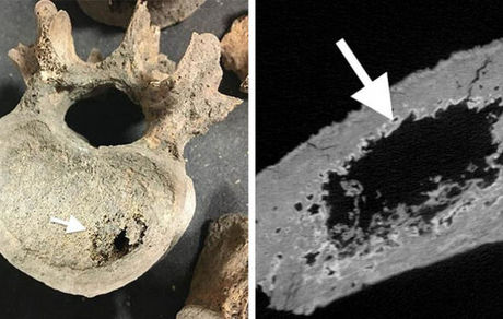سرطان در قرون وسطی هم شایع بوده است!