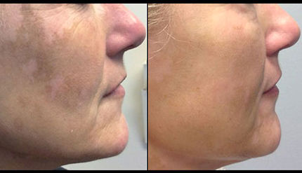 بیماری ویتیلیگو از دیدگاه طب سنتی ایران