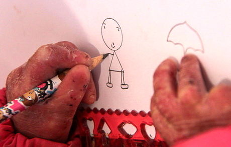 حدود ۸۰۰ بیمار پروانه‌ای در کشور و درخواست «خاص» شدن این بیماران