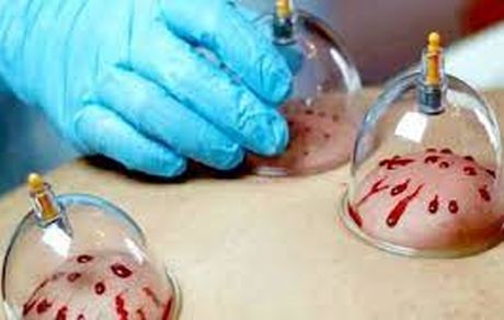 جایگاه حجامت و بایدها و نبایدهای آن از دیدگاه طب سنتی