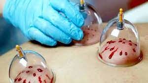 جایگاه حجامت و بایدها و نبایدهای آن از دیدگاه طب سنتی