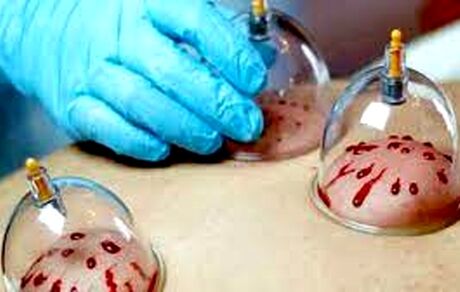 جایگاه حجامت و بایدها و نبایدهای آن از دیدگاه طب سنتی