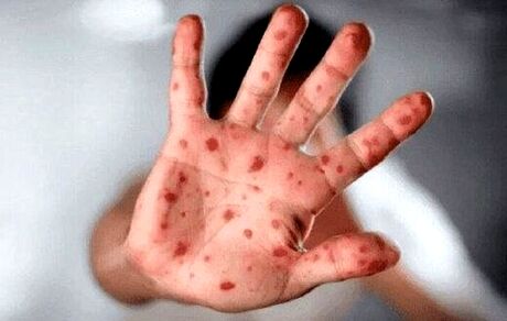 سازمان جهانی بهداشت، نام بیماری آبله میمونی را تغییر داد