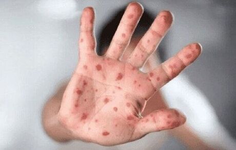 سازمان جهانی بهداشت، نام بیماری آبله میمونی را تغییر داد
