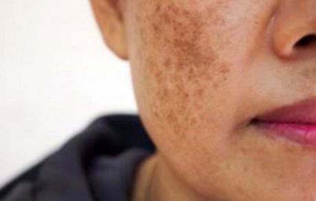 ابداع روشی برای تشخیص ابتلا به سرطان پوست در یک دقیقه