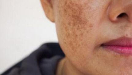 ابداع روشی برای تشخیص ابتلا به سرطان پوست در یک دقیقه