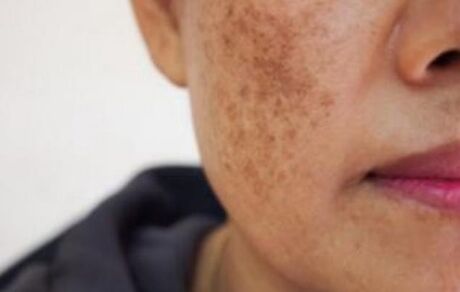 ابداع روشی برای تشخیص ابتلا به سرطان پوست در یک دقیقه