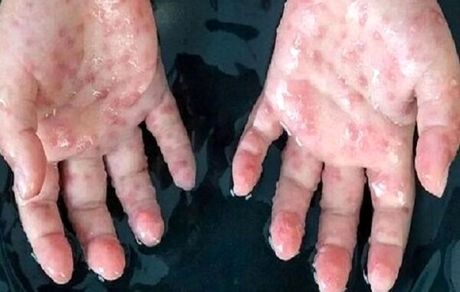 انجام نمونه برداری از بیمار بابلی مشکوک به آبله میمونی