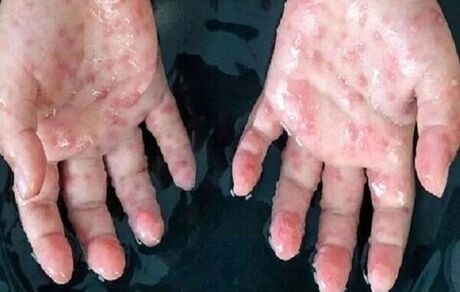 انجام نمونه برداری از بیمار بابلی مشکوک به آبله میمونی