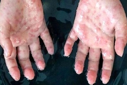 انجام نمونه برداری از بیمار بابلی مشکوک به آبله میمونی
