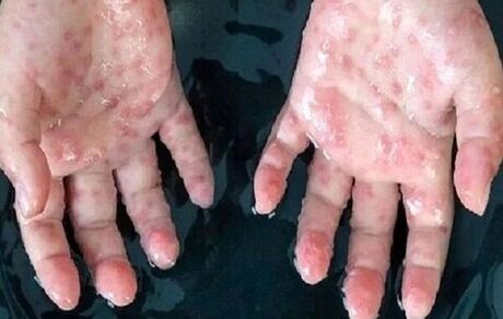 انجام نمونه برداری از بیمار بابلی مشکوک به آبله میمونی