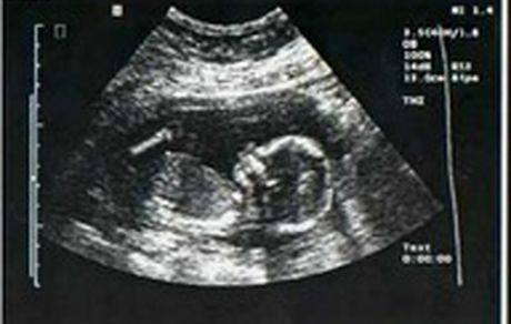 توضیح وزارت بهداشت درباره یک نامه؛ غربالگری جنین و ثبت آن در سامانه ممنوع نشده است