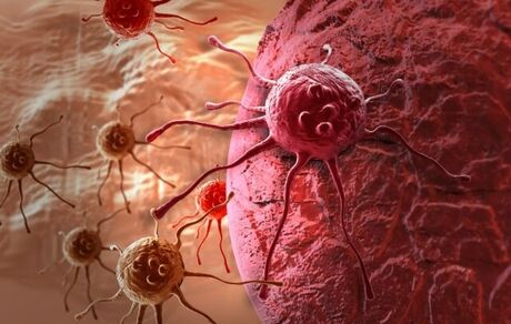 تشخیص زودهنگام سرطان پروستات با کمک یک نرم‌افزار مبتنی بر هوش مصنوعی