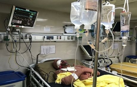 کمبود ۲۰۰۰ تخت سوختگی در کشور 