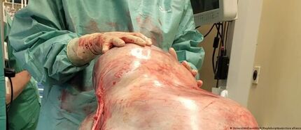 خارج کردن غده ۳۲ کیلویی از شکم یک زن ۲۴ سال