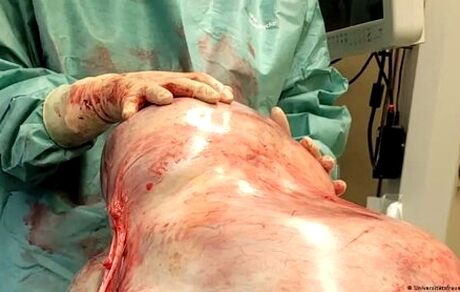 خارج کردن غده ۳۲ کیلویی از شکم یک زن ۲۴ سال