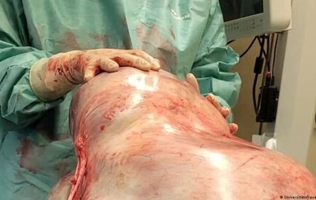 خارج کردن غده ۳۲ کیلویی از شکم یک زن ۲۴ سال