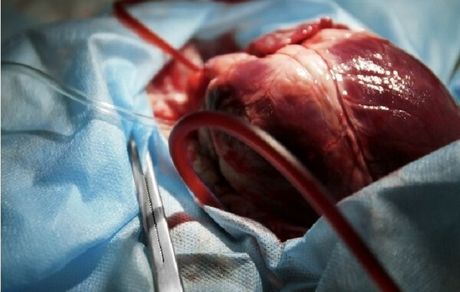 ۶ کودک با روش نوین پیوند صاحب قلب جدید شدند