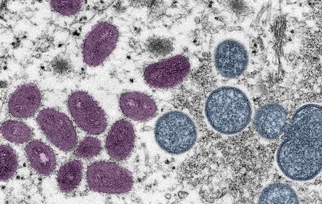 اولین فوتی آبله میمونی در خارج از آفریقا ثبت شد