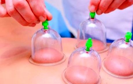 بادکش درمانی در طب ایرانی
