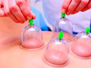 بادکش درمانی در طب ایرانی