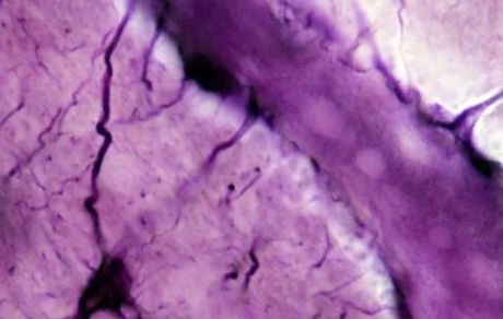 نوعی چربی مسئول انتقال پروتئین ایجاد کننده آلزایمر به مغز است