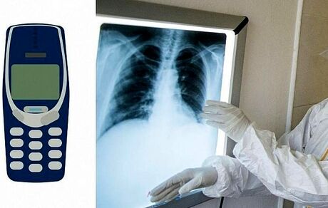 پیدا شدن و خارج کردن یک گوشی موبایل توکیا از معده یک زندانی