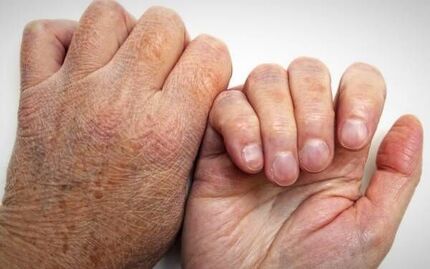 شناسایی ۱۲ هزار بیمار مبتلا به جذام