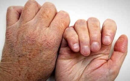 شناسایی ۱۲ هزار بیمار مبتلا به جذام