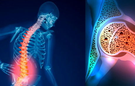 ۵۰ هزار سال عمر مفید ایرانی‌ها تحت‌تاثیر پوکی استخوان/ ناتوانی پوکی استخوان بیشتر از سرطان