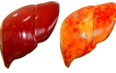 کبد چرب را با طب سنتی درمان کنید