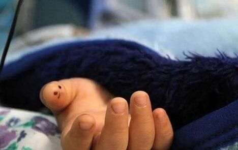 مرگ یک دختر بچه سه‌ساله بر اثر عقرب‌ گزیدگی